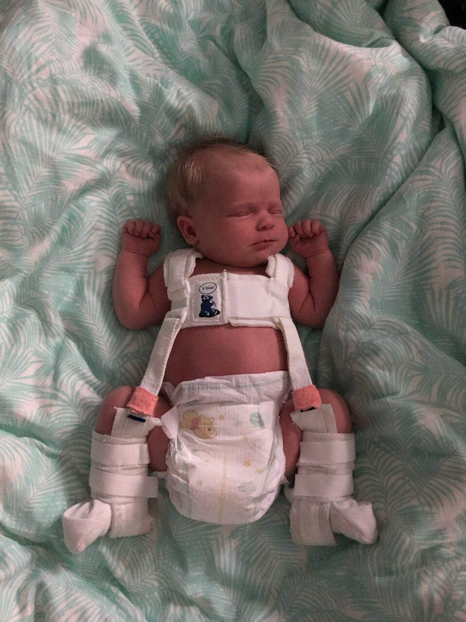 baby with hip dysplacia wearing pavlik harness