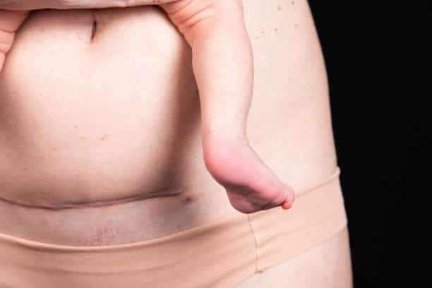 Scar on the skin of a person, woman, keloid after cesarean section. 30 days after the birth of the child.